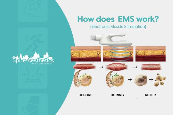 EMS treatment for post pregnancy weight loss treatment Stroud