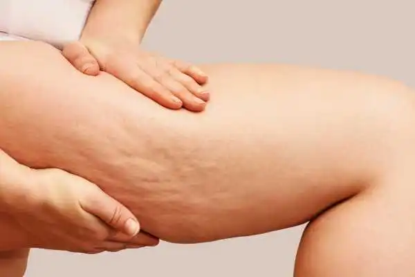 Image of woman showing leg with cellulite Stroud