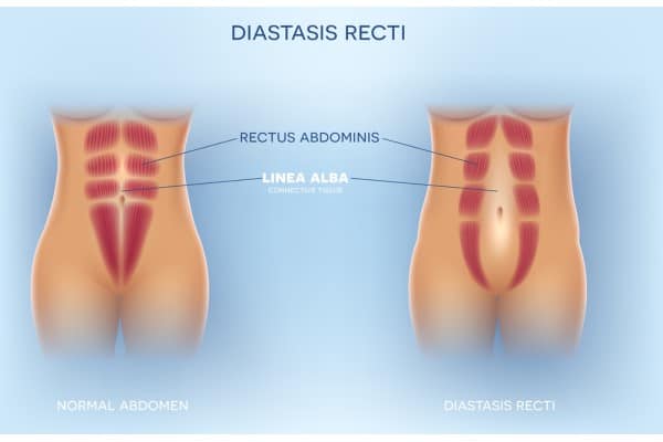 What Non-Surgical Options Are Available for Diastasis Recti Stroud?