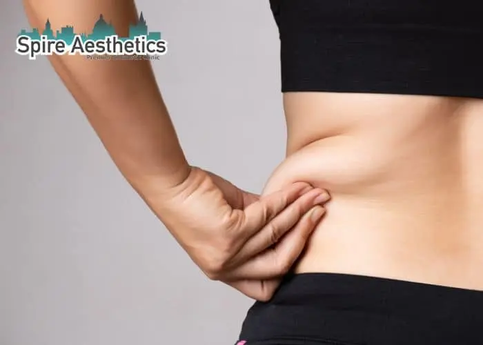 Image of woman pinching fat on their hips Stroud. Fat Freezing treatment