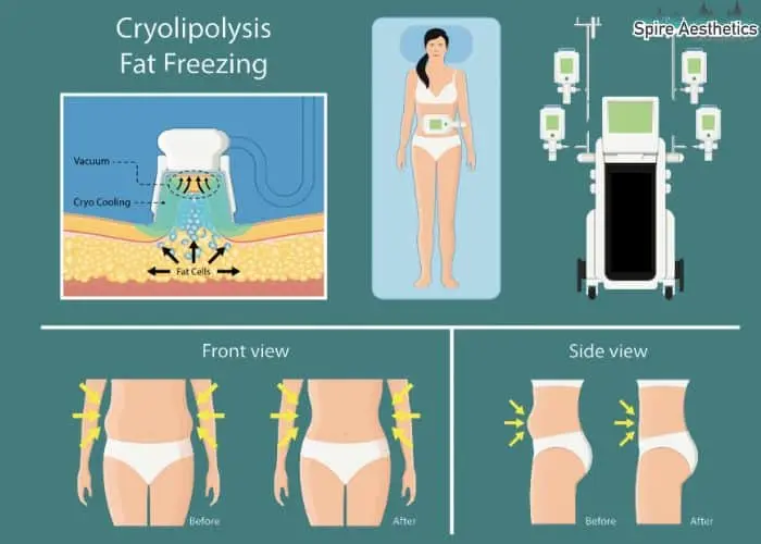 Fat freezing treatment Stroud benefits for competitions to remove stubborn fat deposits.