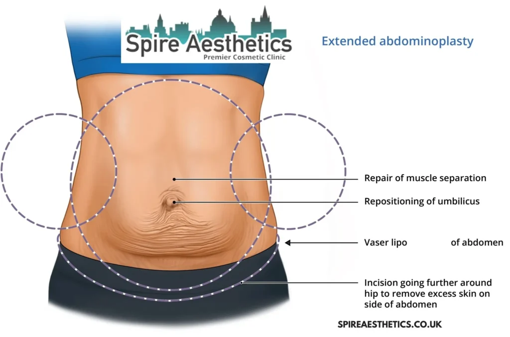 Understanding Loose Skin After Gastric Band Stroud Surgery and HIFU Treatment