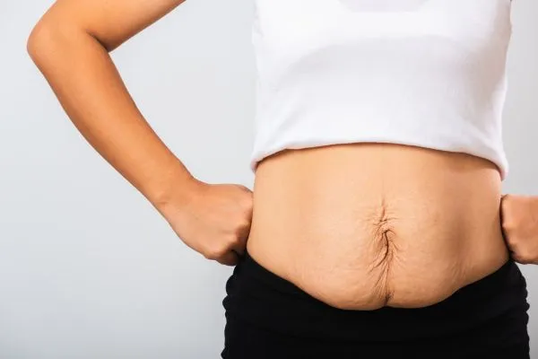 Image of a woman's stomach after weight loss with sagging skin following a gastric band Stroud