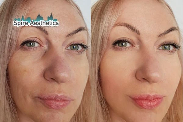 Morpheus8 Treatment Stroud Before & After Results
