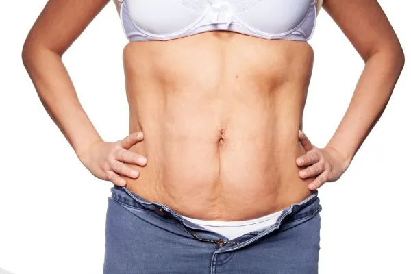 sagging skin on woman's stomach after weight loss injections Stroud