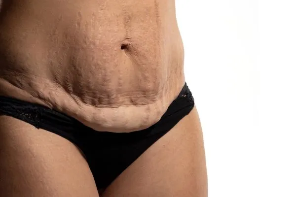 Image of womans stomach after weight loss injections Stroud showing saggy skin