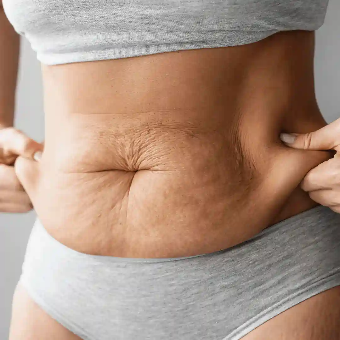 Is It Normal to Have Loose Skin After Pregnancy Stroud?