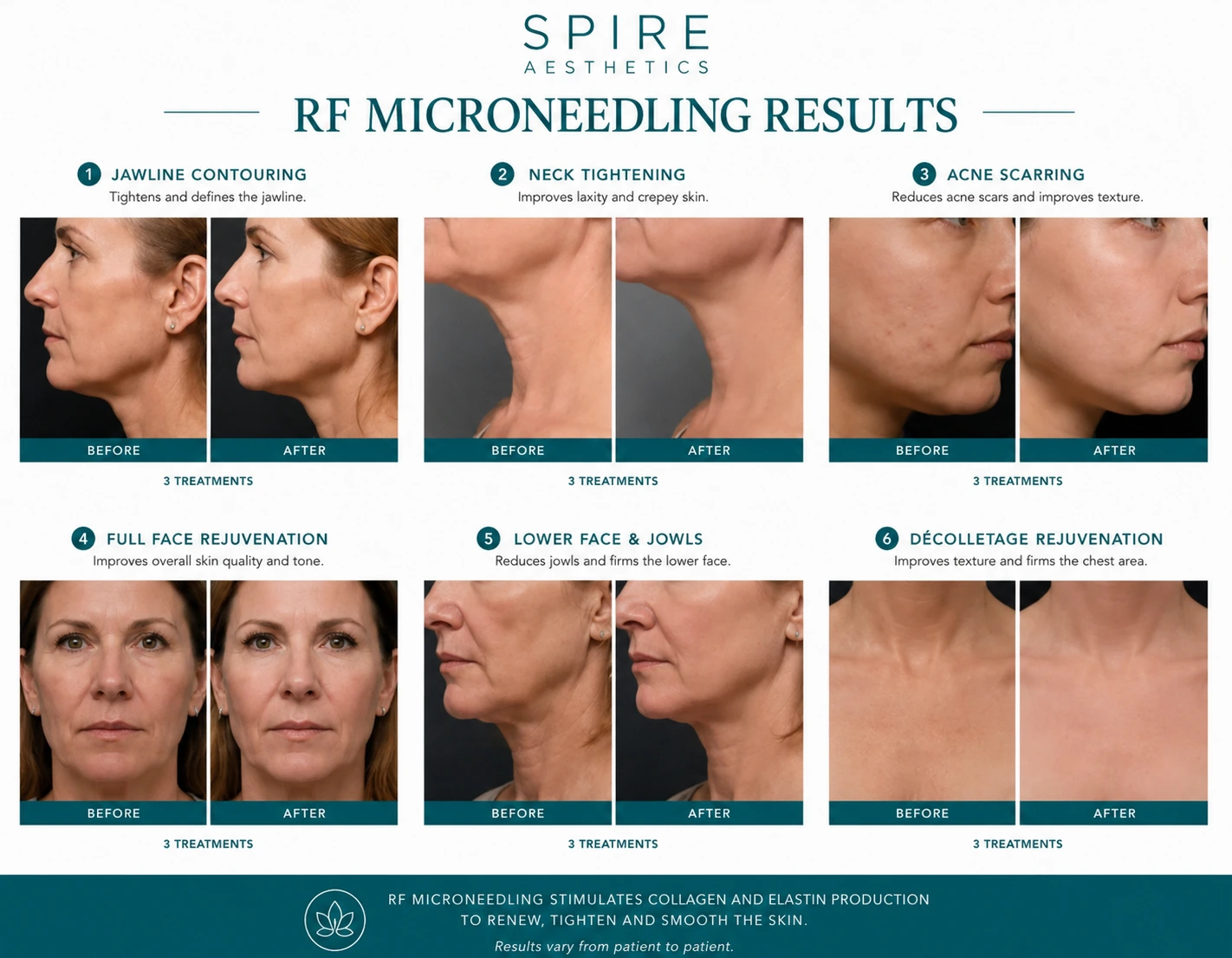RF Microneedling Skin tightening Stroud results