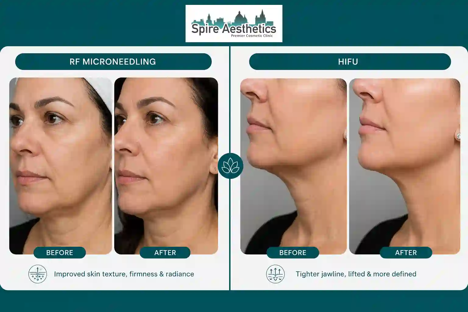 Can RF Microneedling and HIFU Be Combined Stroud?