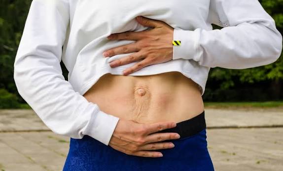 When Could Diastasis Recti Be the Missing Piece of the Puzzle Stroud?