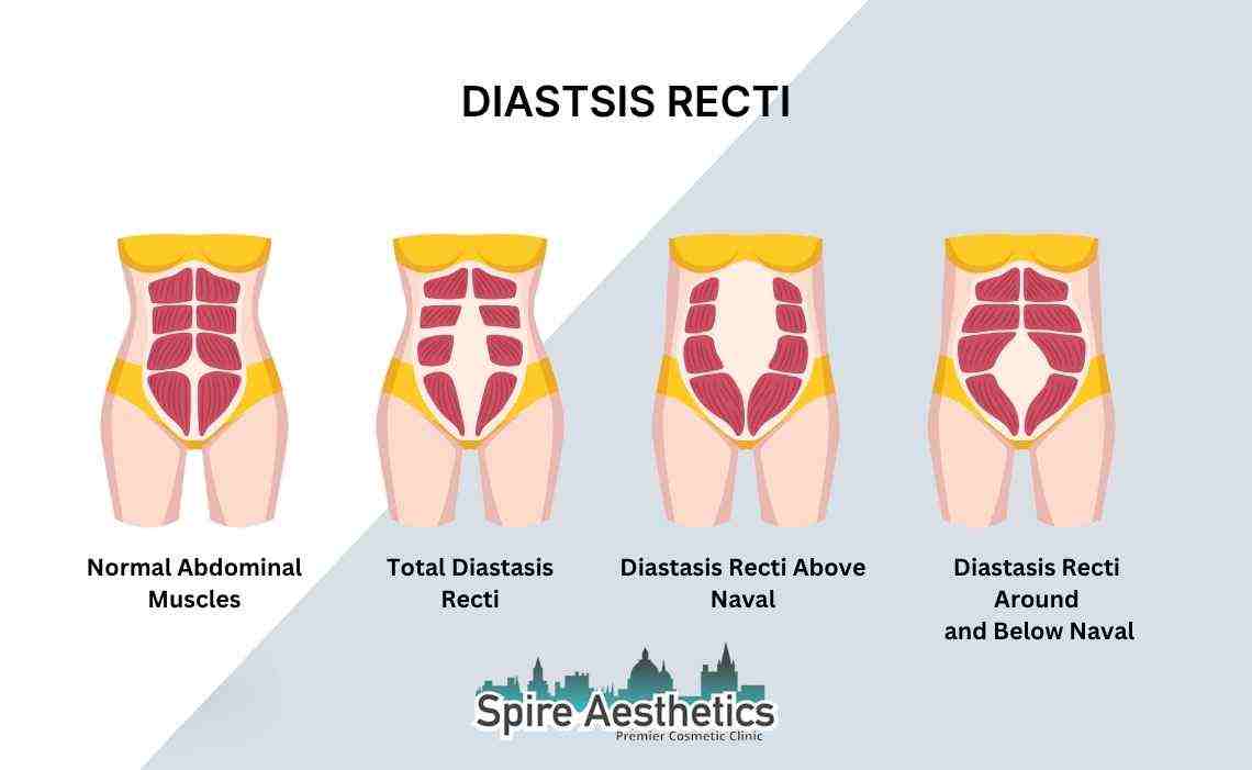 Is Non-Surgical Diastasis Recti Treatment Right for You? Common Concerns Answered Stroud